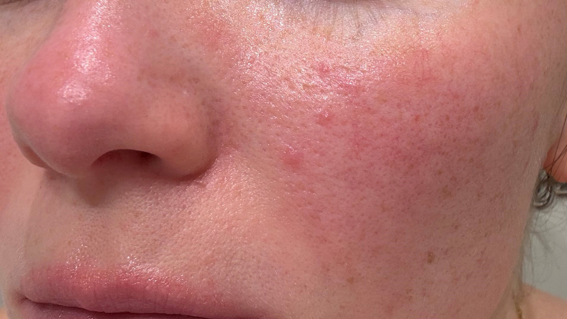 Rosaceaudbrud på kind_Close-up